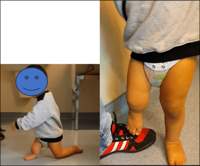 New Reconstruction Technique in Combined Tibial and Fibular Hemimelia.