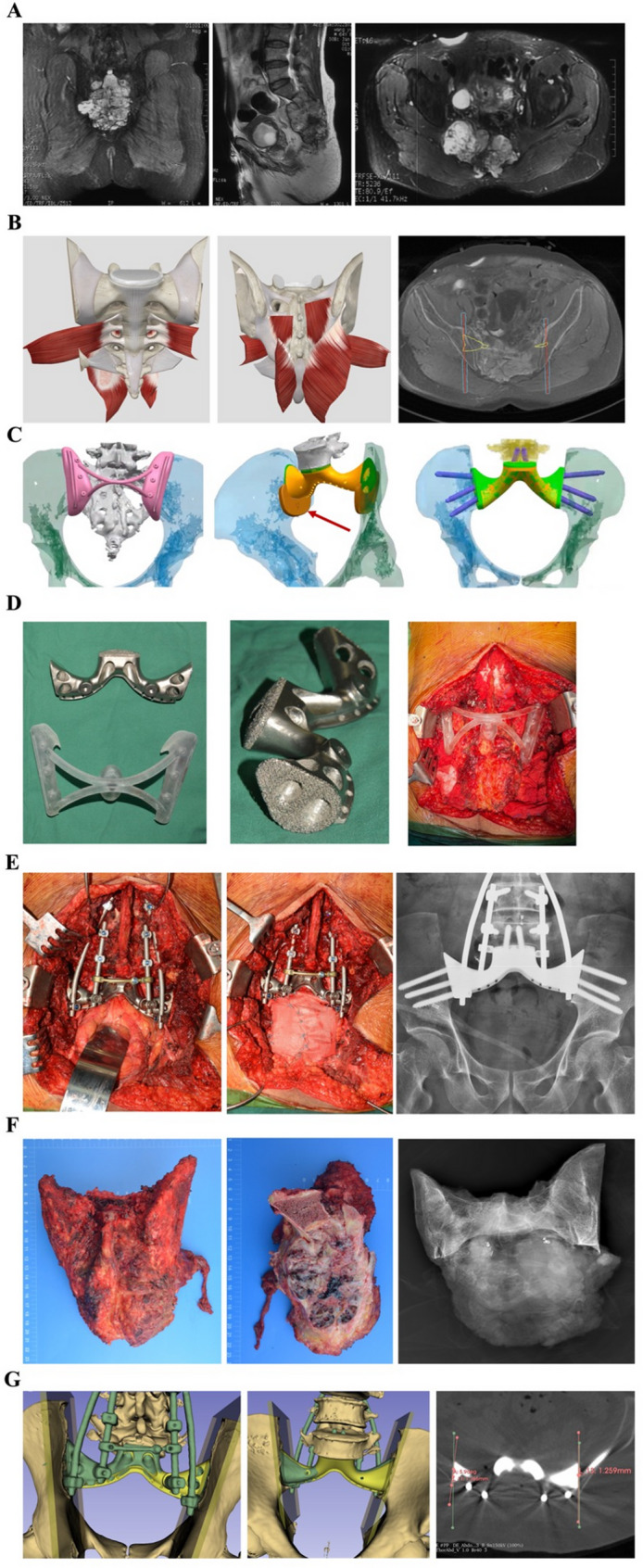 How precise is excision and reconstruction using 3D printing technology for total sacrectomy: accuracy validation in 9 consecutive cases.