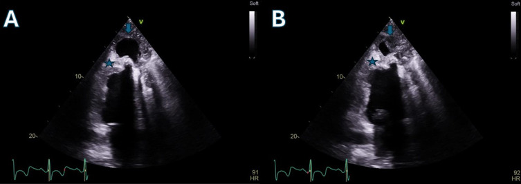 A Traumatic and Infected Left Ventricular Pseudoaneurysm 2 years After the Explantation of a Bridge-to-Recovery Left Ventricular Assist Device.