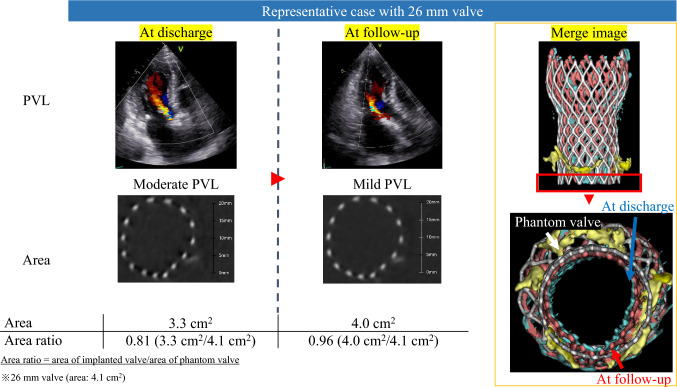 The relationship between chronic expansion of self-expandable valves and paravalvular leakage in transcatheter aortic valve implantation.