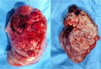 Paraneoplastic Hypoglycaemia in a Patient With Solitary Fibrous Tumor of Pleura.