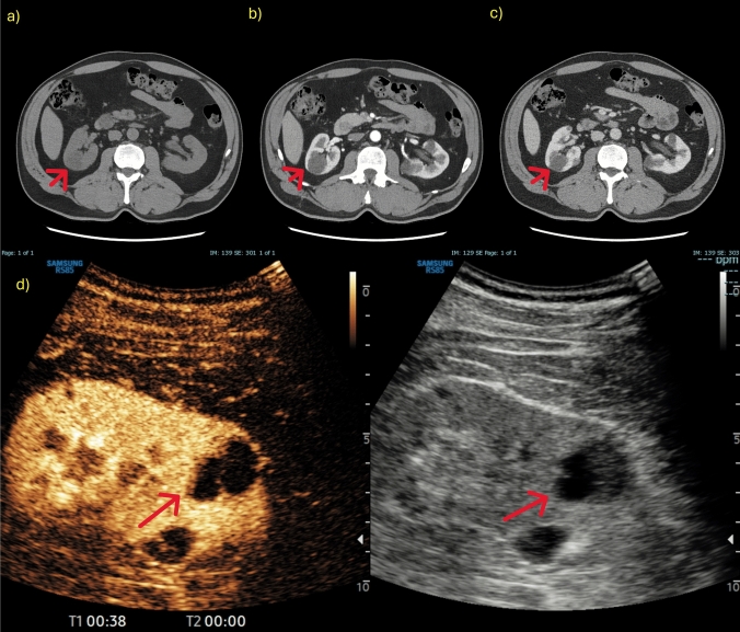 Contrast-enhanced ultrasound in the evaluation and management of solid renal lesions based on EFSUMB guidelines.