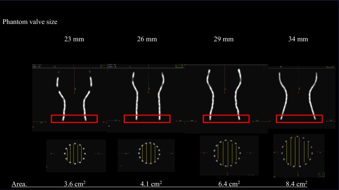 The relationship between chronic expansion of self-expandable valves and paravalvular leakage in transcatheter aortic valve implantation.