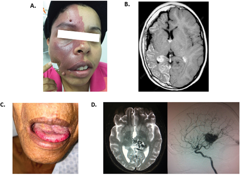 A diagnostic approach to neurocutaneous syndromes.