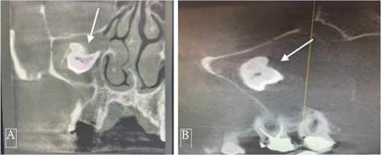 A Rare Case Report of a Large Dentigerous Cyst in the Maxillary Sinus Associated With an Ectopic Maxillary Third Molar.