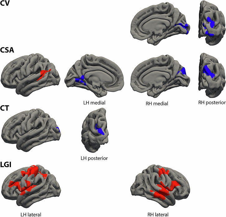 Differential structural cortical correlates of positive, negative, and linguistic control formal thought disorder dimensions in schizophrenia.