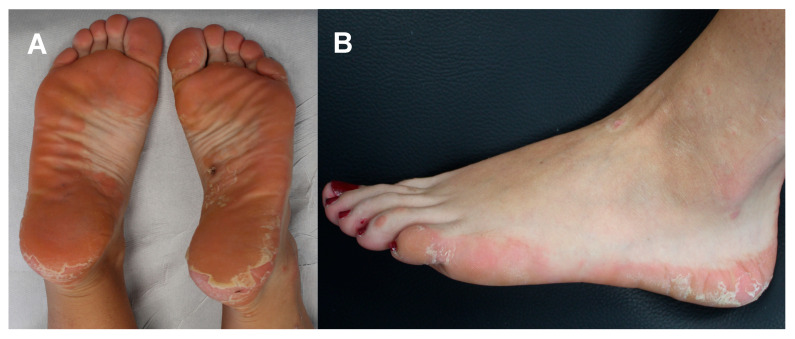 Efficacy of Dupilumab in a Young Woman with Refractory Cutaneous Lichen Planus: A Case-Based Review.