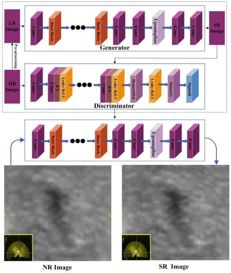 The application of super-resolution ultrasound radiomics models in predicting the failure of conservative treatment for ectopic pregnancy.