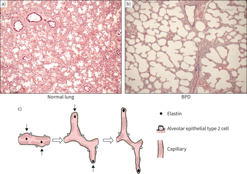 The pathogenesis of bronchopulmonary dysplasia: "It is never the heart, it is always the lung" - myth or maxim?