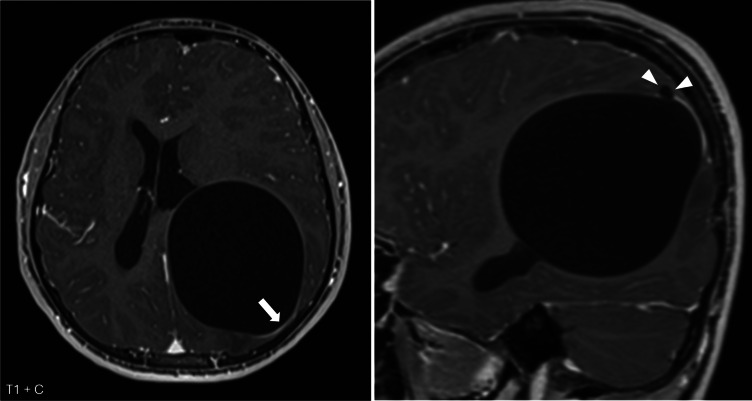 A Rare Presentation of a Hydatid Cyst in the Brain.