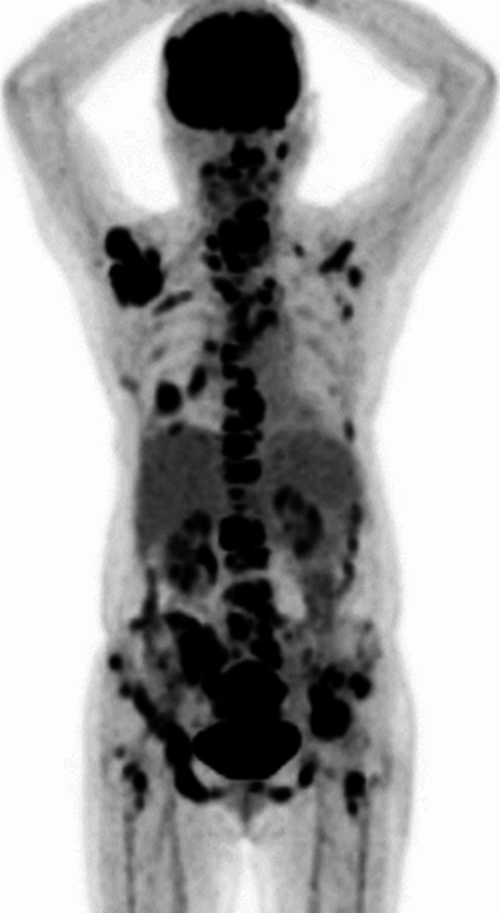 A Case Report on the Development of Ulcerative Colitis During Osimertinib Therapy for Epidermal Growth Factor Receptor Mutation-Positive Non-Small-Cell Lung Cancer.