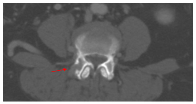 Late Onset Malignant Metastatic Transformation of Benign Pheochromocytoma.