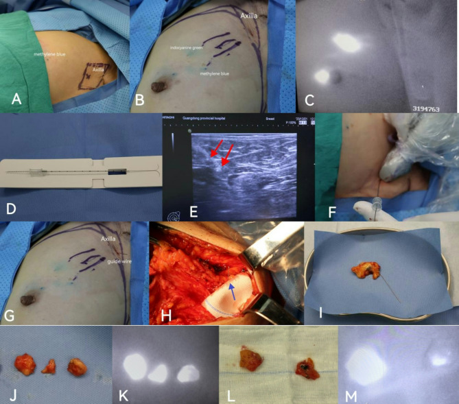 Intraoperative ultrasound-guided wire(IOUS-wire) localization biopsy versus preoperative fine needle aspiration cytology(FNAC) for early breast cancer with clinically positive nodes, a retrospective cohort study.