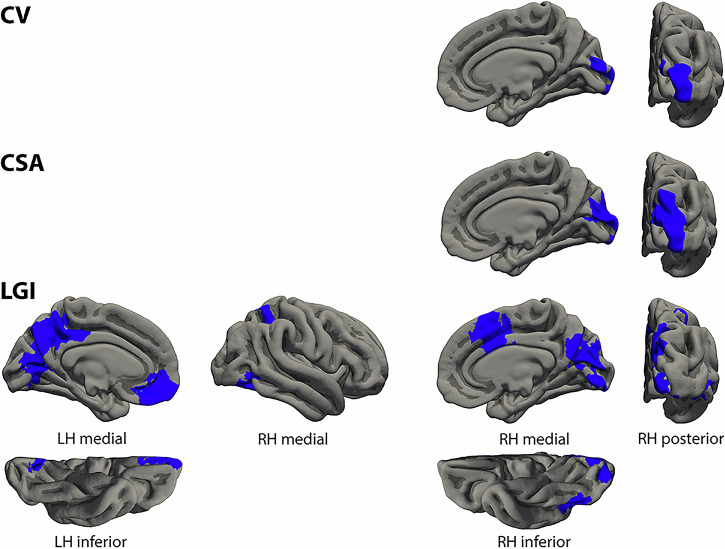 Differential structural cortical correlates of positive, negative, and linguistic control formal thought disorder dimensions in schizophrenia.