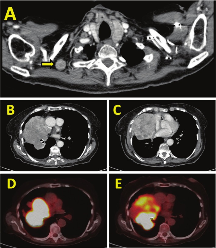 Primary Pulmonary Leiomyosarcoma: A Case of Prolonged Survival With Radiotherapy and Pazopanib in a 90-Year-Old Female.