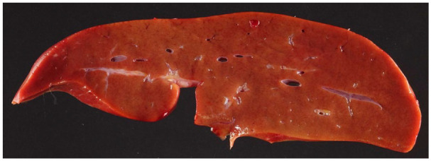 Nodular Regenerative Hyperplasia Is a Frequent Finding in Explanted Livers of Patients With Maple Syrup Urine Disease.