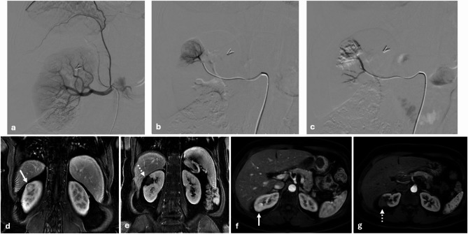 Microwave ablation versus combined microwave ablation and transarterial chemoembolization for T1a renal cell carcinoma: a Single-Center retrospective study.