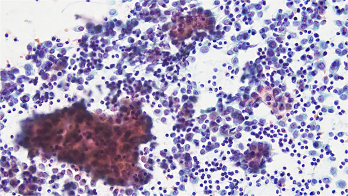 A Case of False-Negative Results in the One-Step Nucleic Acid Amplification Assay for Sentinel Lymph Node Metastasis in Breast Cancer with Low Cytokeratin 19 Expression.