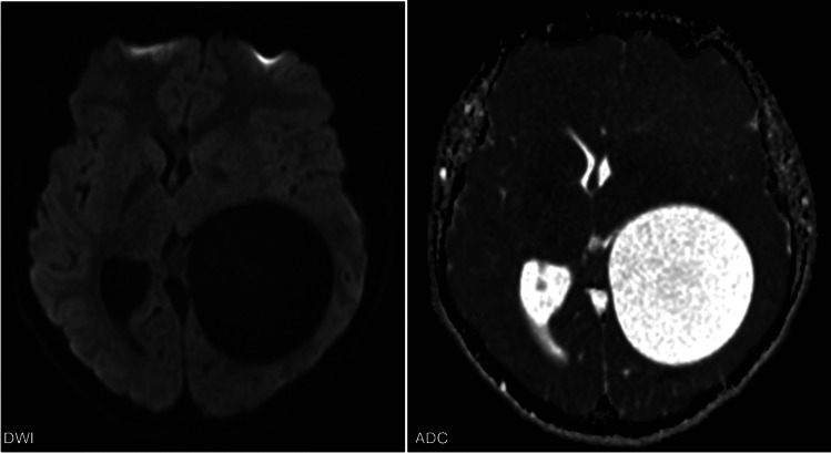 A Rare Presentation of a Hydatid Cyst in the Brain.