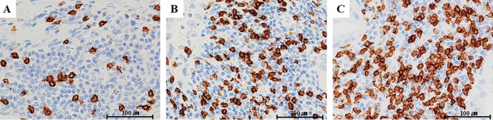 Insight Into the Significance of CD8+ Tumor-Infiltrating Lymphocytes in Lung Adenocarcinoma.