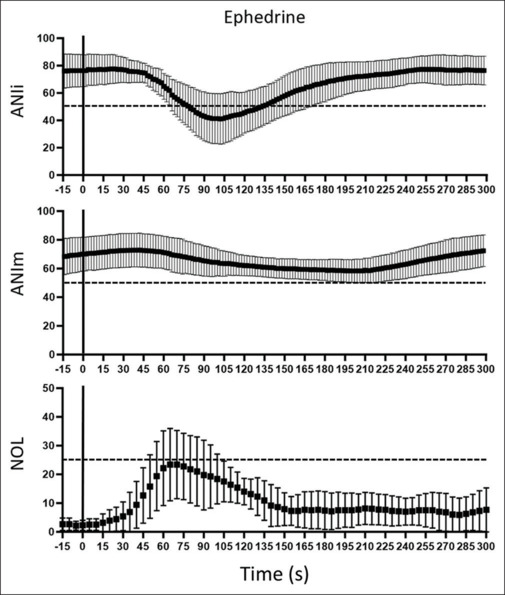 Effects of ephedrine on the nociception level and analgesia nociception index: A prospective observational study.