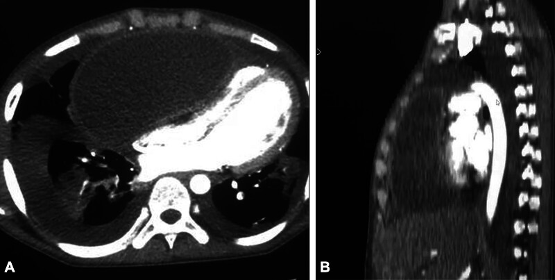 Cardiac Tamponade Secondary to a Giant Pleuropericardial Cyst in a Child: A Surgical Case Report from Sub-Saharan Africa.