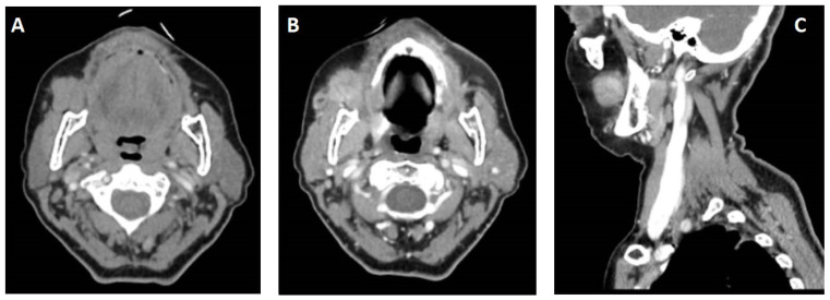 Polymorphous adenocarcinoma: a review of the literature and presentation of a case in an uncommon anatomical area.