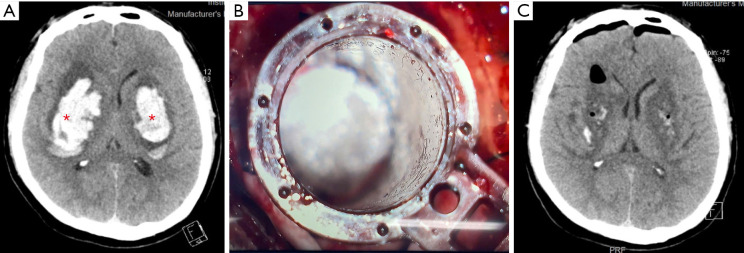 Minimally invasive surgery for bilateral large basal ganglia hemorrhage: a rare case report and insights from literature.
