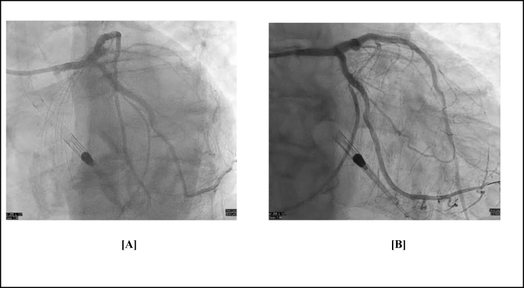 Navigating high-risk PCI with axillary impella support: a case report.