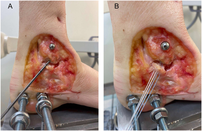 Effects of Fibular Plate Fixation and Deep Posterior Tibiotalar Ligament Repair on Ankle Stability in a Weber B Fracture Model with Complete Deltoid Ligament Sectioning.