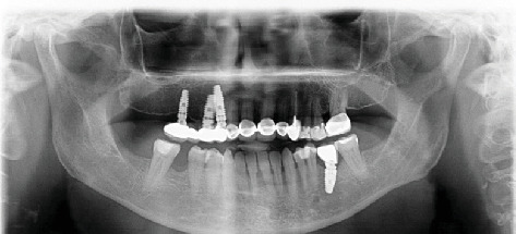 Implant Osseointegration Adjacent to a Retained Root Fragment: A Case With 11-Year Follow-up.