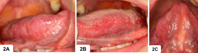 Vegetative pyodermatitis-pyostomatitis in a patient with Crohn's disease: a clinical case report.