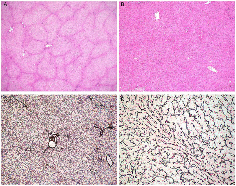 Nodular Regenerative Hyperplasia Is a Frequent Finding in Explanted Livers of Patients With Maple Syrup Urine Disease.