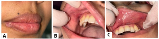 Identifying the Multifactorial Triggers of Monthly Recurrent HSV-1 Reactivation: A Case Report.