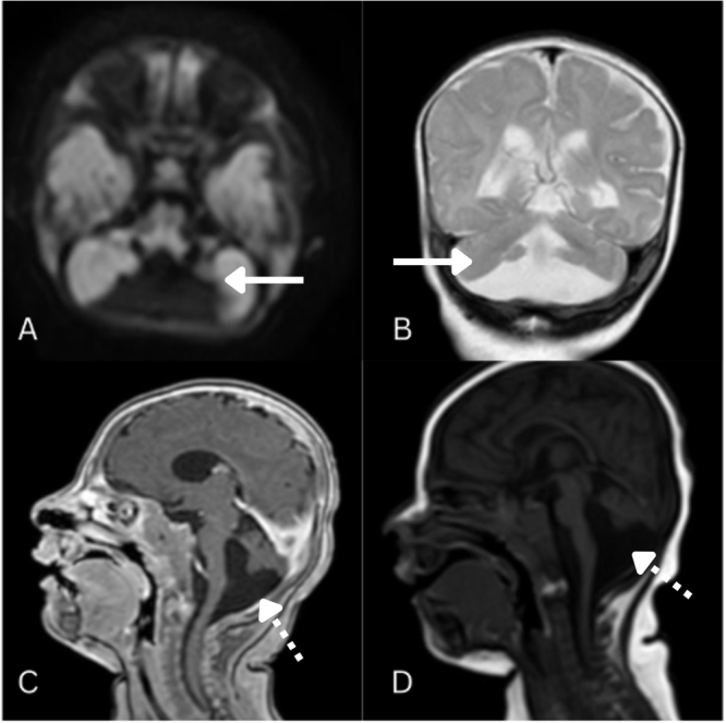 Dandy-Walker spectrum with bilateral optic atrophy and seizure disorder: a case report and literature review.