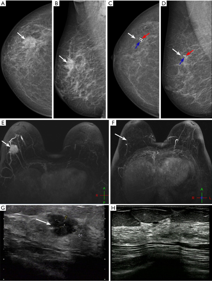 Minimally invasive biopsy technique predicting breast pathological complete response after neoadjuvant therapy for breast cancer.