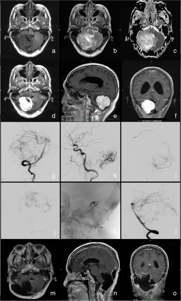 One-stage hybrid operation for hypervascular central nervous system tumors: a single-center experience of 31 cases.
