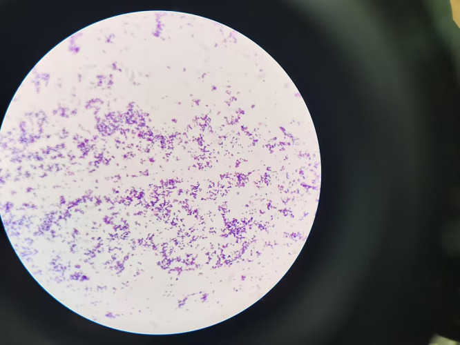 Infection Leading to Breast Abscess Formation in Pregnancy: A Case Report.