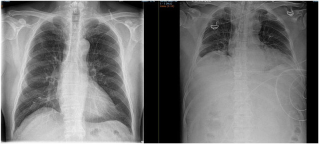 Refractory metabolic acidosis and acute abdominal compartment syndrome following Holmium Laser Enucleation of Prostate (HoLEP).