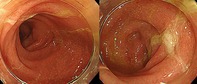 A Case Report on the Development of Ulcerative Colitis During Osimertinib Therapy for Epidermal Growth Factor Receptor Mutation-Positive Non-Small-Cell Lung Cancer.