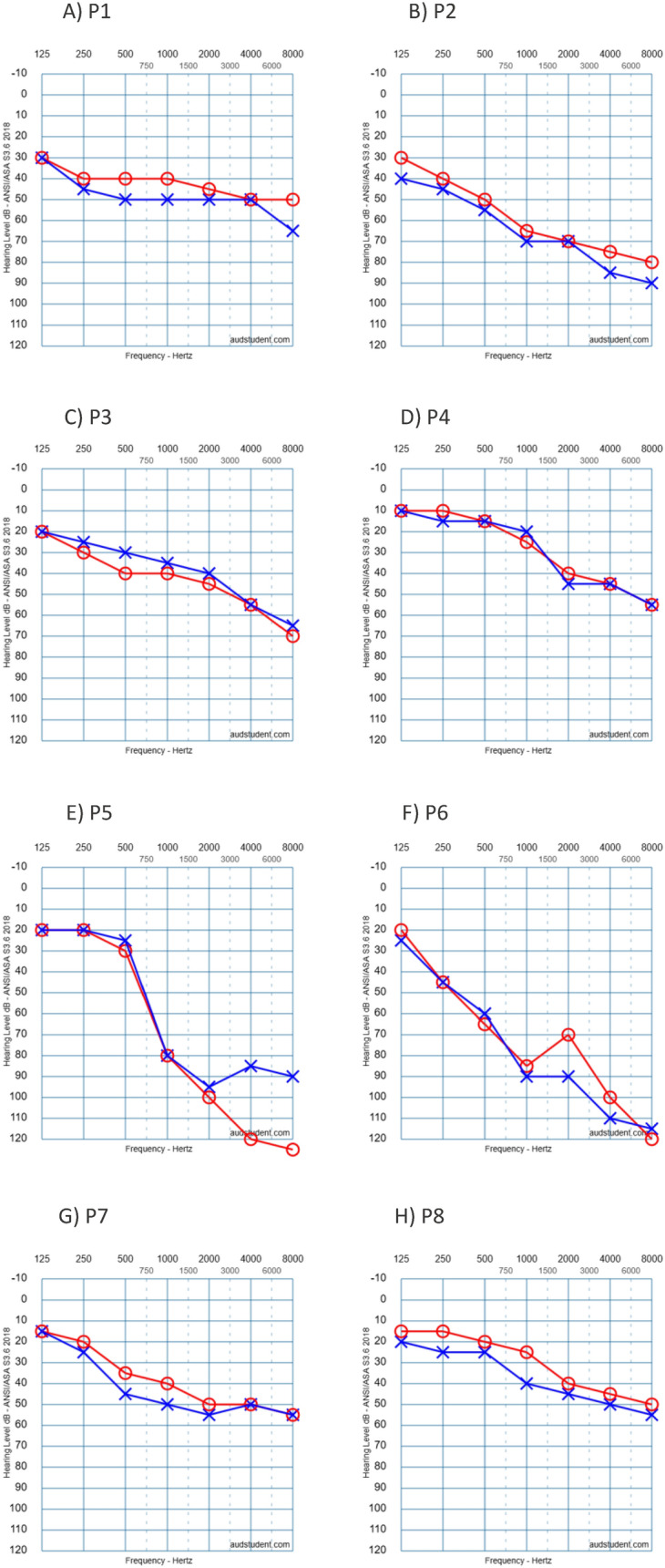 Hearing loss secondary to novel variants of the KCNQ4 gene.