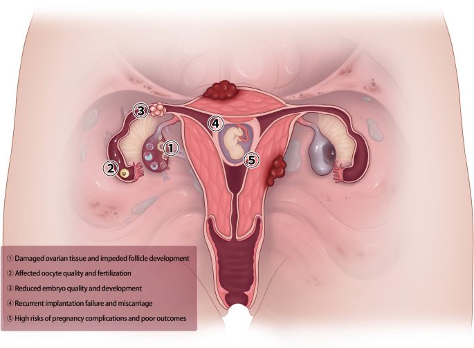 Immunopathological insights into endometriosis: from research advances to future treatments.