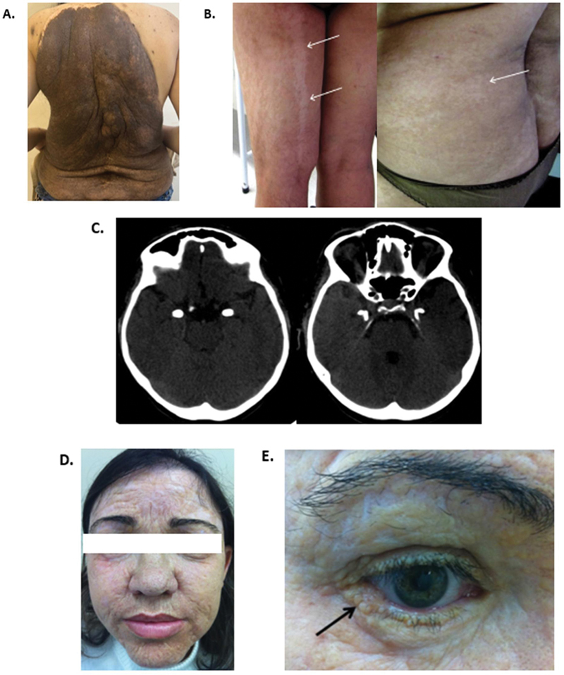 A diagnostic approach to neurocutaneous syndromes.