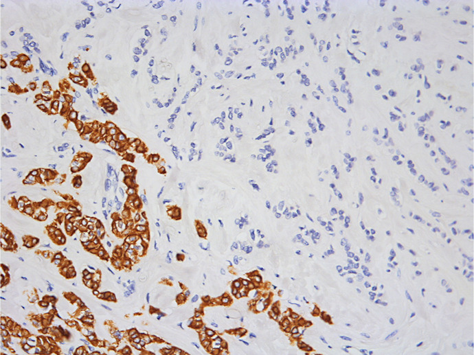 A Case of False-Negative Results in the One-Step Nucleic Acid Amplification Assay for Sentinel Lymph Node Metastasis in Breast Cancer with Low Cytokeratin 19 Expression.