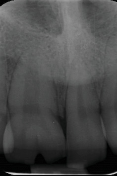 Esthetic Management in Geminated and Supernumerary Maxillary Incisor Teeth With a Conservative Interdisciplinary Approach.