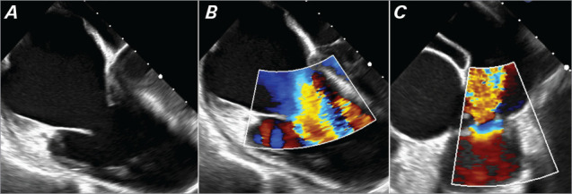 Complex Tricuspid and Pulmonic Carcinoid Heart Disease With Timely Surgical Repair.