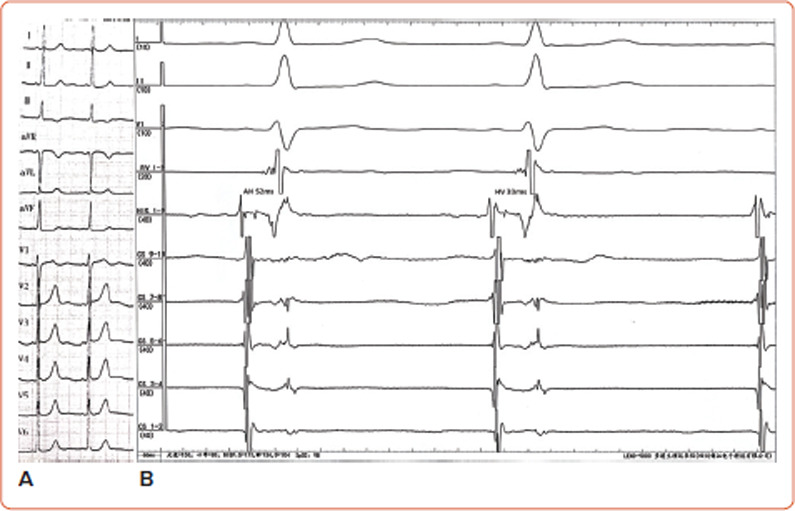A Fasciculoventricular Accessory Pathway Featuring Functional Decremental Conduction and QRS Variability.