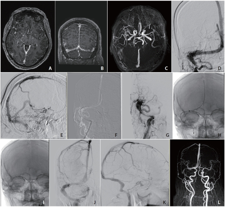 Venous Sinus Stenting Alone as an Effective Treatment for Complex Dural Arteriovenous Fistulas with Sinus Thrombosis.