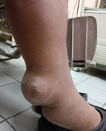 Lymphoedema - Filariasis or soft tissue sarcoma? A case report.