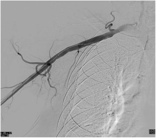 Navigating high-risk PCI with axillary impella support: a case report.